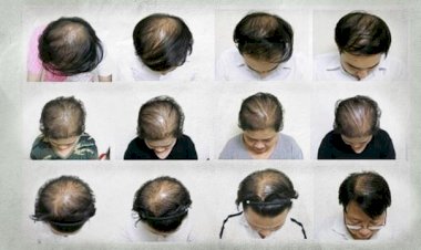 İnsanoğlu kellikten kurtuluyor mu?