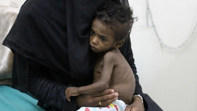 Yemen'de her 10 dakikada bir çocuk yetersiz beslenme ve önlenebilir hastalıklar yüzünden ölüyor