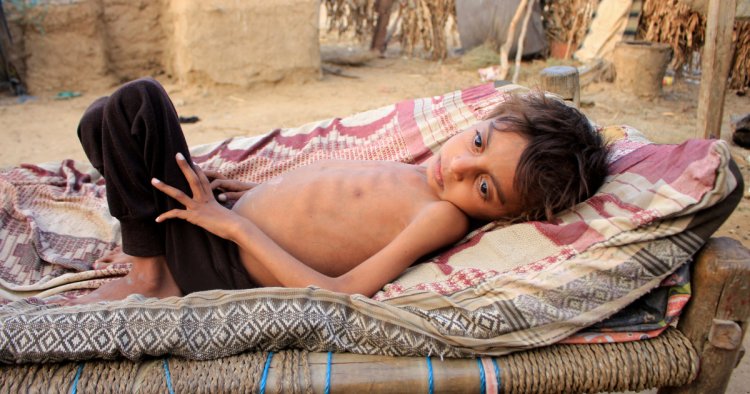 Yemen’de 2,2 milyon çocuk yetersiz beslenme ve salgın hastalık riski altında