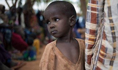 Somali'de çocuklar yetersiz beslenme nedeniyle ölüyor
