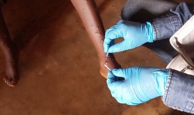 UNICEF, Afrika'daki mpox hastalığıyla mücadele için 16,5 milyon dolar arıyor