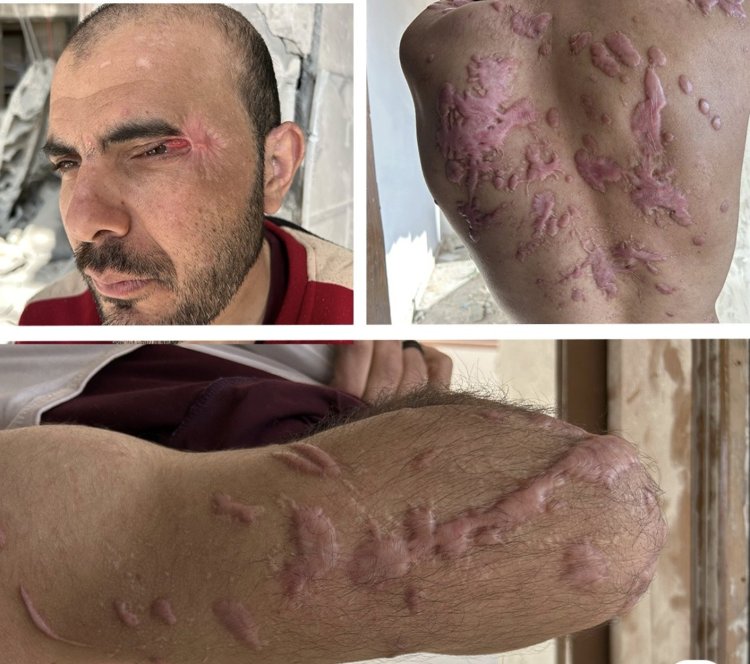 Gazze’den Sde Teiman’a: Bir mühendisin gözünü alan, bedenini yakan kimyasal işkence