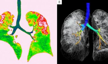 Koronavirüs kalıcı hasara neden oluyor